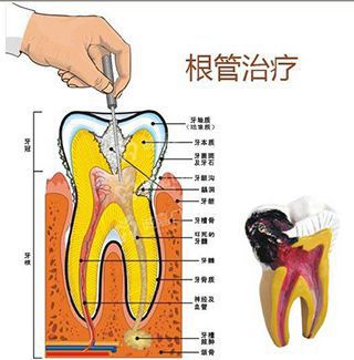 牙髓炎