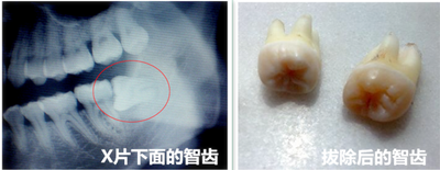 拔除后的智齿